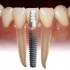 Implantology