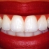 Teeth whitening